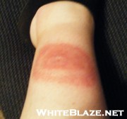 Lyme Disease Rash