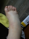 Fat Ankle